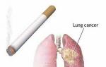 Lung cancer: etiology, classification, clinical picture and treatment